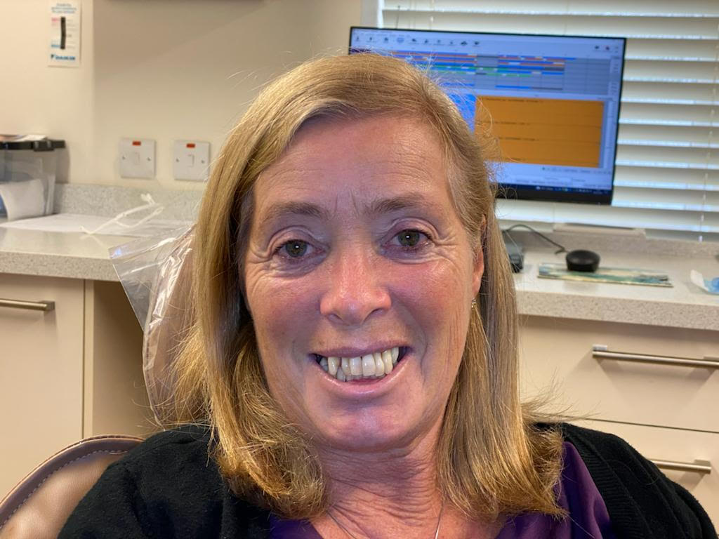 Allon4 dental implants in West Bridgford Replace a full set of